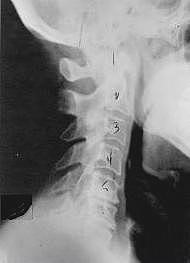 Degeneração da Subluxação Vertebral