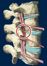 Degeneração da Subluxação Vertebral