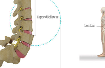 espondilolistese